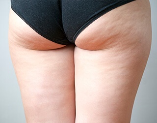 What method best suits you to reduce cellulite?