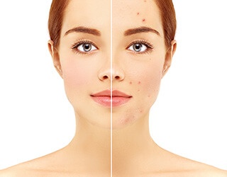 What can be done to improve acne scarring?